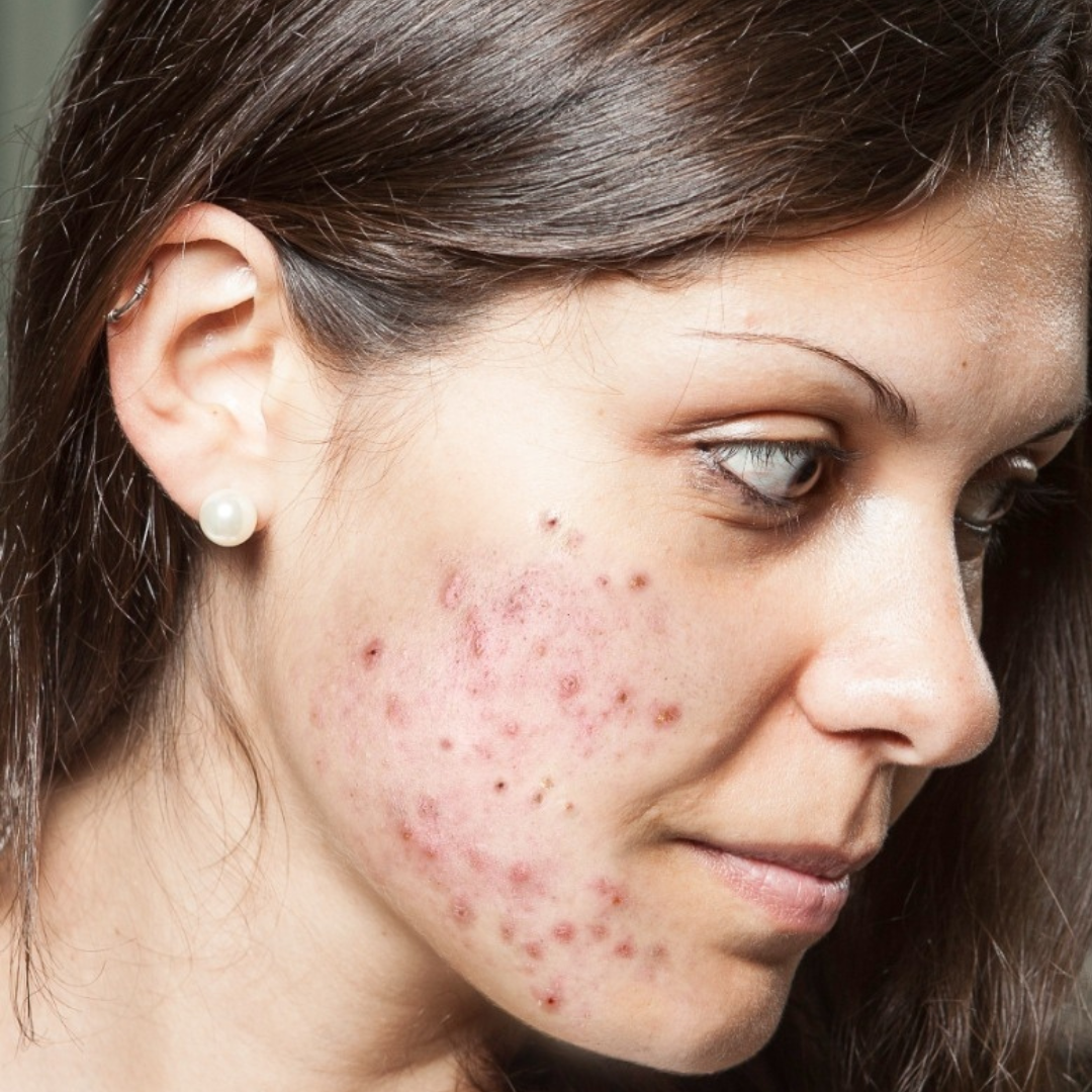 Acne Scar Reduction Before image