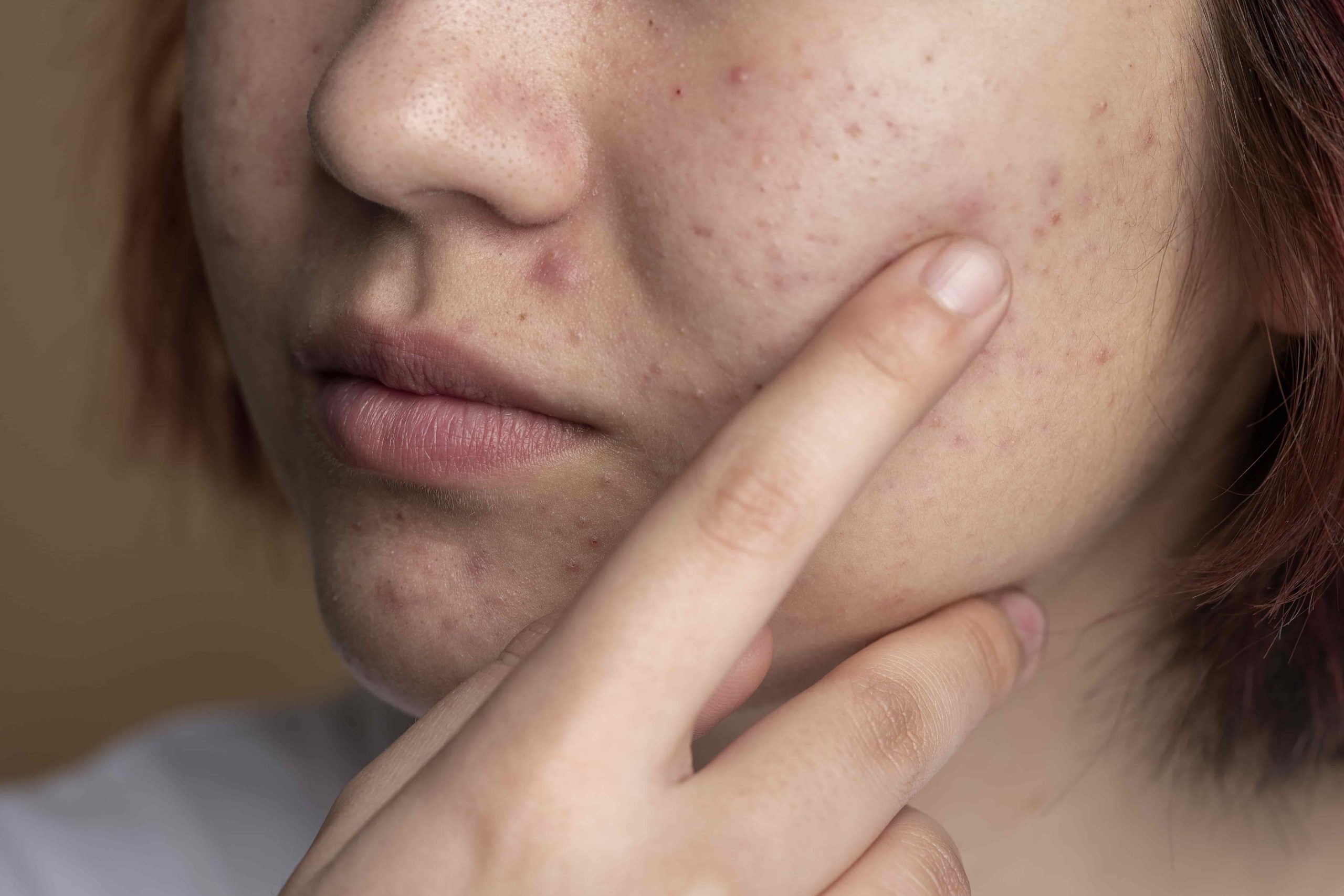 Ance treatment in hyderabad - Dr Sudhavani